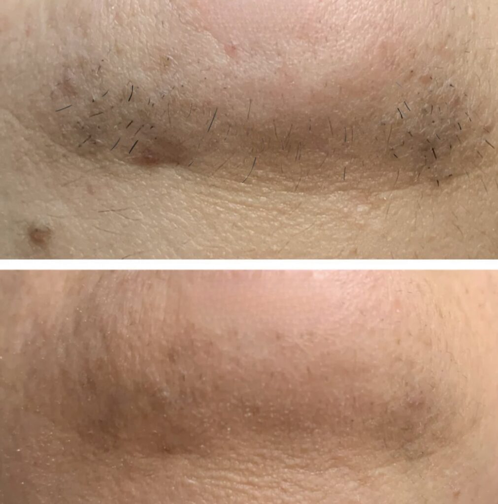 shinie vorher nachher Test